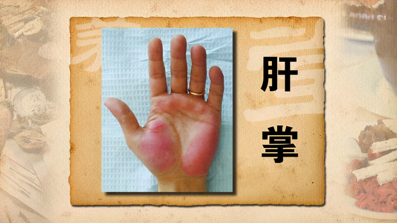 肝掌症状肝掌的表现