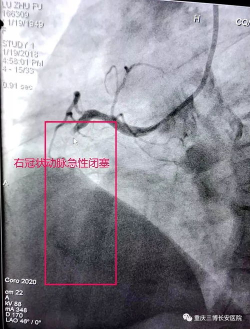心脏气急气喘怎么办 心脏气急气喘怎么办吃什么药 心脏气急气喘怎么办 心脏气急气喘怎么办吃什么药
