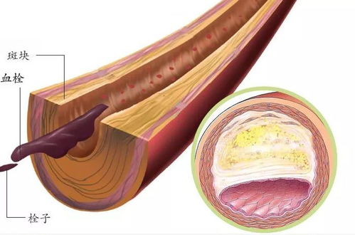 高血压人能不能吃葛根粉 高血压人能不能吃葛根粉