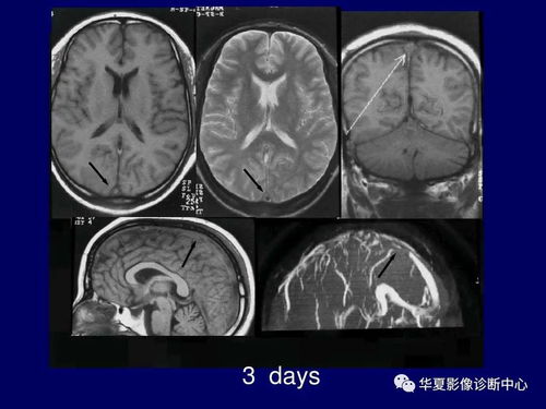 翼状胬肉有什么症状 翼状胬肉有什么症状