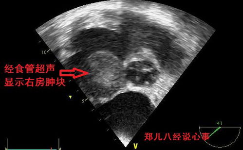 心脏血管较狭窄的原因 心脏血管较狭窄的原因
