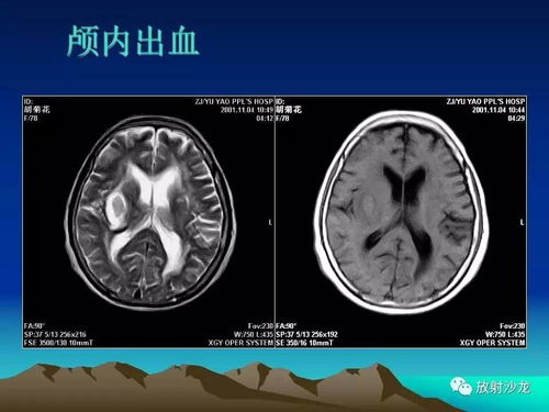 心脏病指甲大 心脏病指甲有什么症状 心脏病指甲大 心脏病指甲有什么症状