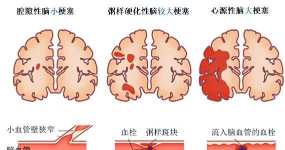风湿性心脏病微创 风湿性心脏病微创手术多少钱 风湿性心脏病微创 风湿性心脏病微创手术多少钱