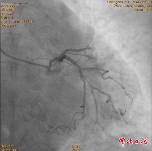 阴虚火旺盛有什么症状 阴虚火旺盛有什么症状
