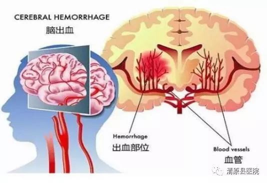 骨关节炎是什么症状 骨关节炎是什么症状