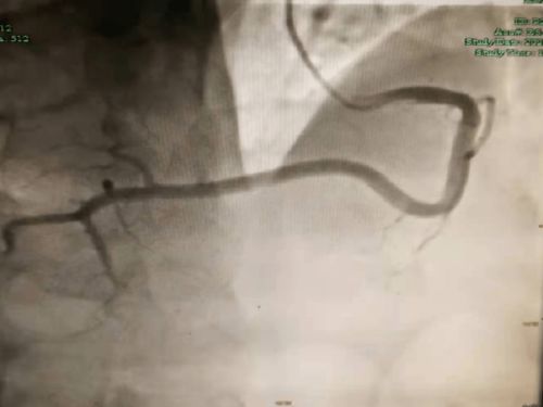心血管疾病的预防按摩 心血管疾病的预防按摩