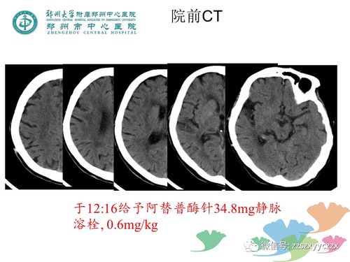 心脏有支架能登珠峰吗 心脏有支架能登珠峰吗