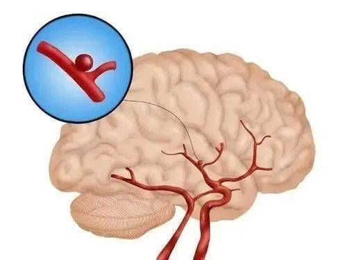 孕妇高血压可以吃蚝油吗 孕妇高血压可以吃蚝油吗