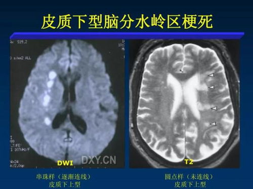 心血管支架重量多少毫升 心血管支架重量多少毫升