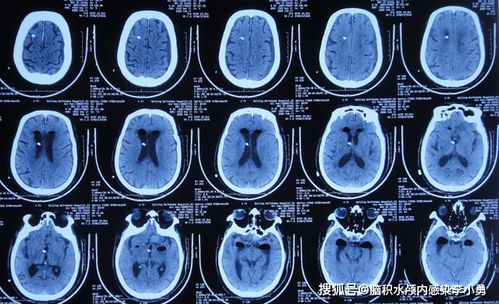 冠心病喝三七保健用量 冠心病喝三七保健用量