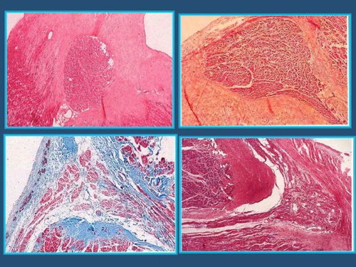 卡痰带血丝是怎么回事 卡痰带血丝是怎么回事