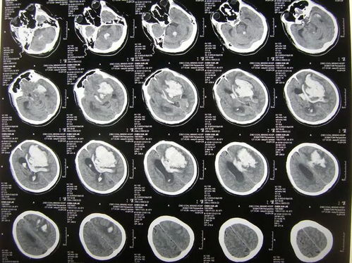 高血压能吃肉类有哪些肉 高血压能吃肉类有哪些肉