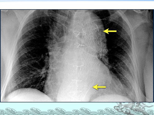 胎儿心脏不好能打麻药吗 胎儿心脏不好能打麻药吗