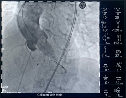 心血管负性重构 什么叫心血管重构 心血管负性重构 什么叫心血管重构