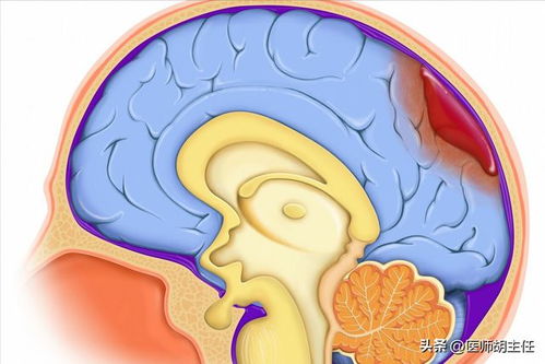 肺癌会导致心脏不舒服 肺癌会导致心脏不舒服