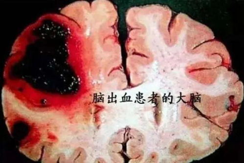 冠心病老人能吃黑鱼吗 冠心病老人能吃黑鱼吗