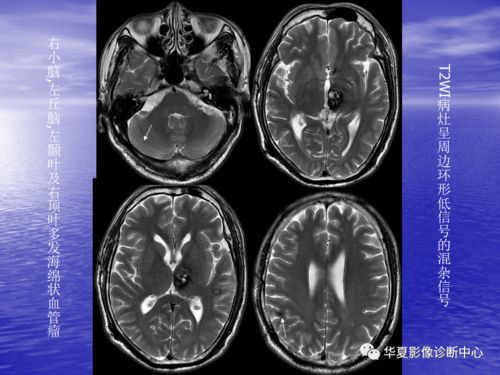 孕妇嗓子里面一直有痰怎么办 孕妇嗓子里面一直有痰怎么办