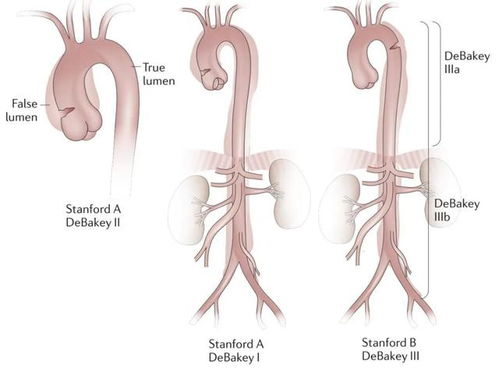 心脏搭桥术后可以活几年 心脏搭桥术后可以活几年