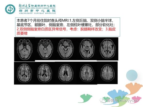 如何预防血管瘤疾病呢 如何预防血管瘤疾病呢