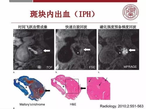 ��Ѫ�ܴ������ ��Ѫ�ܴ໯��ԭ��