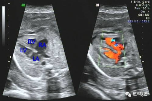 一呼吸就心脏疼 一呼吸就心脏疼是为啥 一呼吸就心脏疼 一呼吸就心脏疼是为啥