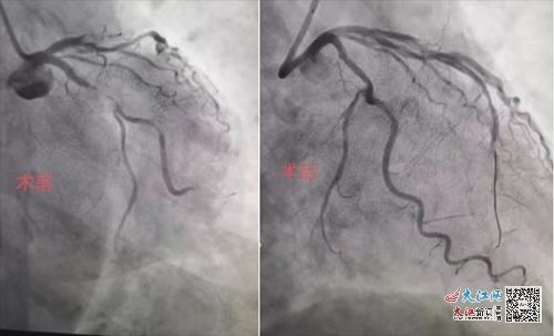 ѪѹɳԼ(ѪѹܳԼлл)