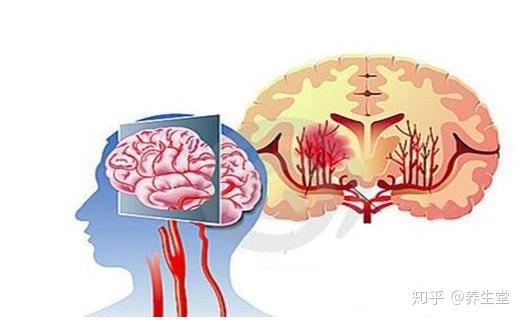 ��Ѫ������ᵼ��ʧ����