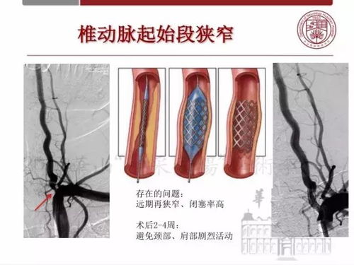 女孩性早熟有什么症状 女孩性早熟有什么症状