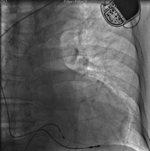 心脏跳特别 心脏跳特别快睡不着 心脏跳特别 心脏跳特别快睡不着