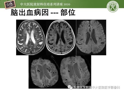 克罗恩病后期的肠外表现有哪些 克罗恩病后期的肠外表现有哪些