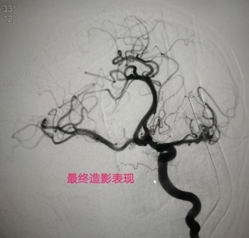 Ѫ�ܴ�Ѫ����Ӱ������