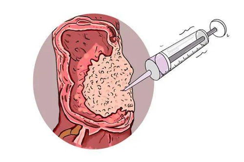 冠心病药要长期吃吗 冠心病药要长期吃吗