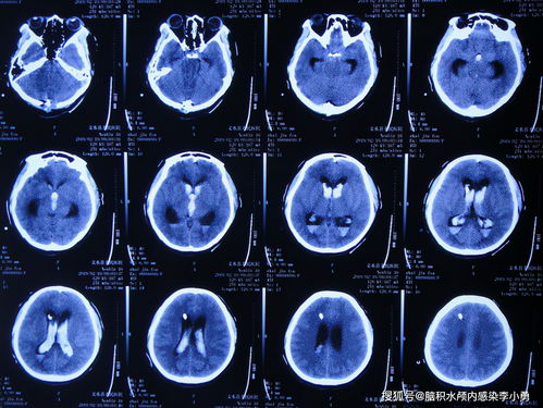 ѪѹƺܺȾ ѪѹȾƺԳҩ